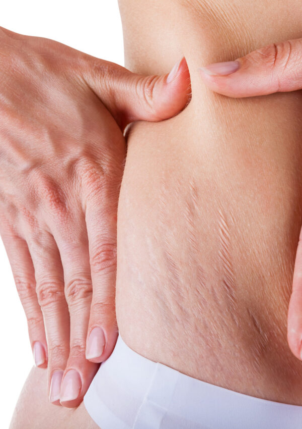 Woman holding loose stretch mark skin zoomed in on belly